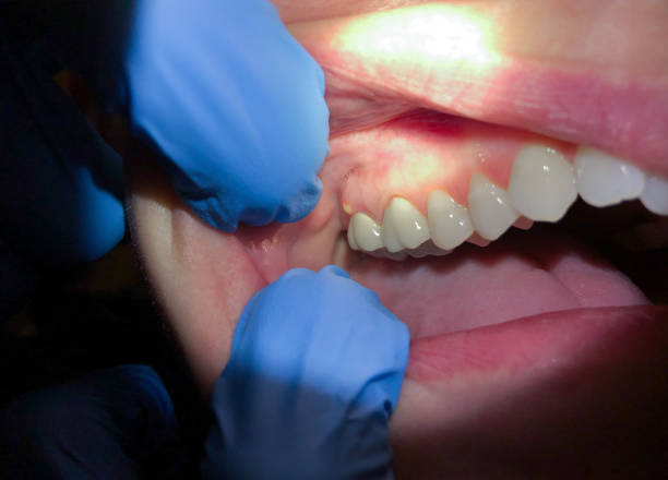 Best Dental Abscess Treatment in Poplar Cotton Center, CA