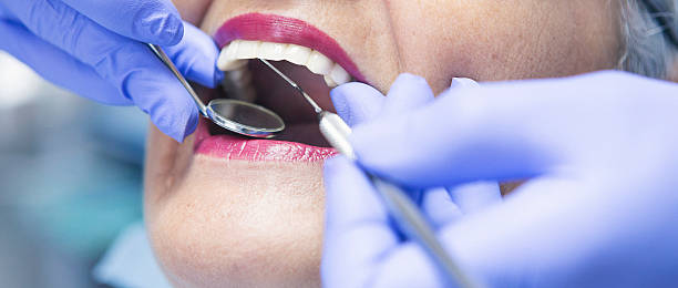 Best Emergency Wisdom Tooth Extraction in Poplar Cotton Center, CA
